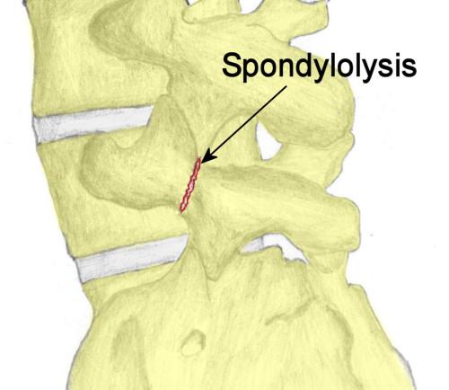 Spondyloysis